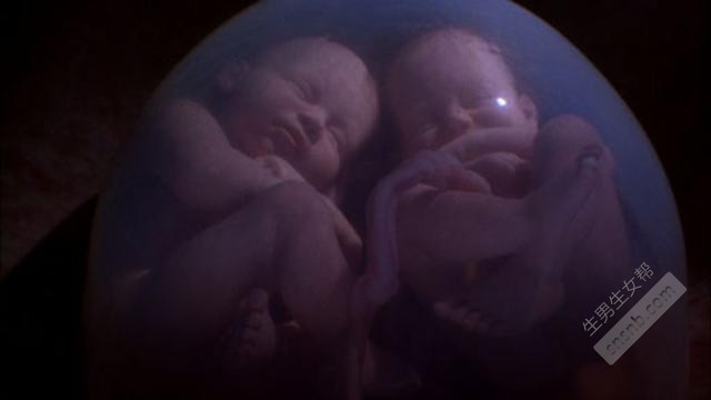 同卵双胞胎中的一种罕见情况。双胞胎中的输血综合症